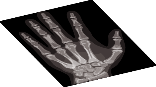 Anatomy illustration of Carpal Tunnel Syndrome