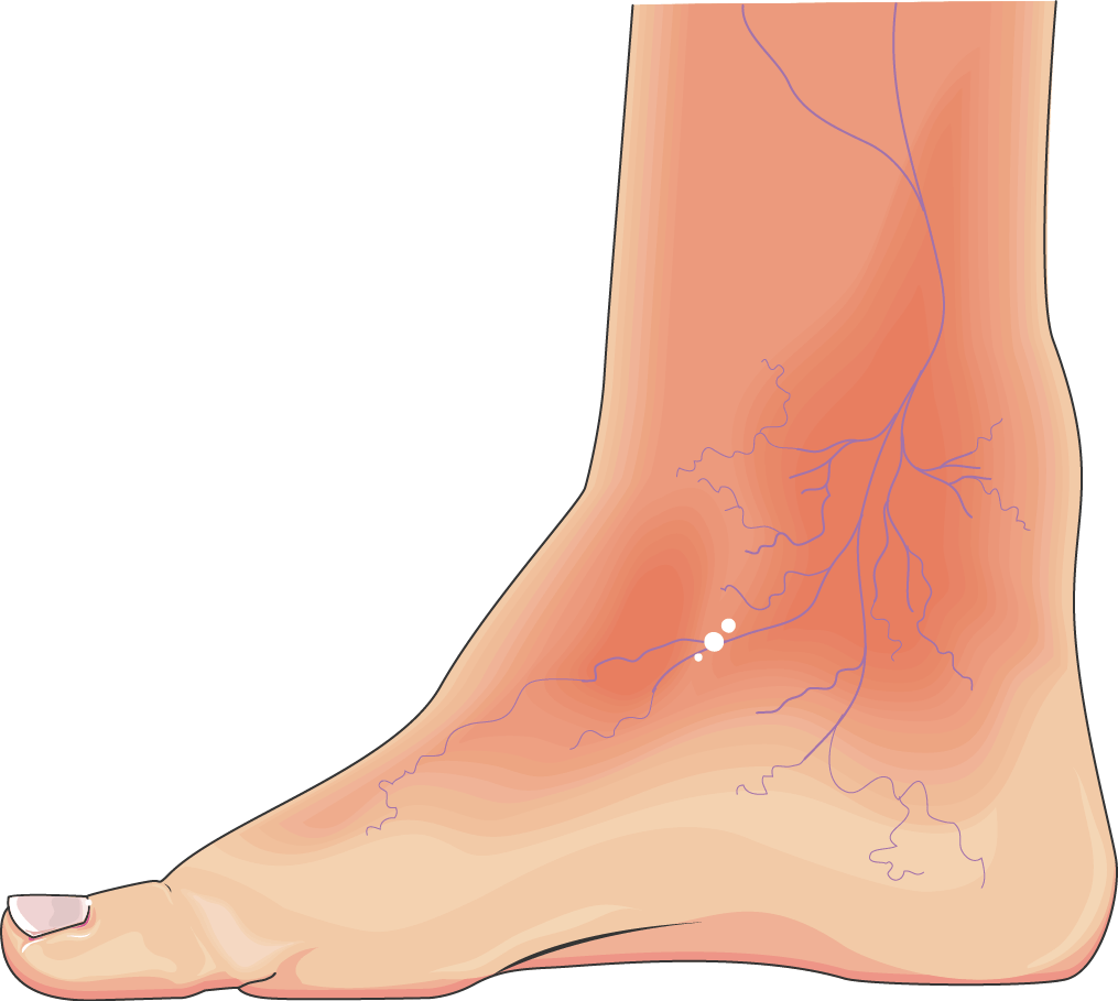 Anatomy illustration of Diabetic Neuropathy