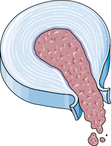 Anatomy illustration of Discogenic Back Pain