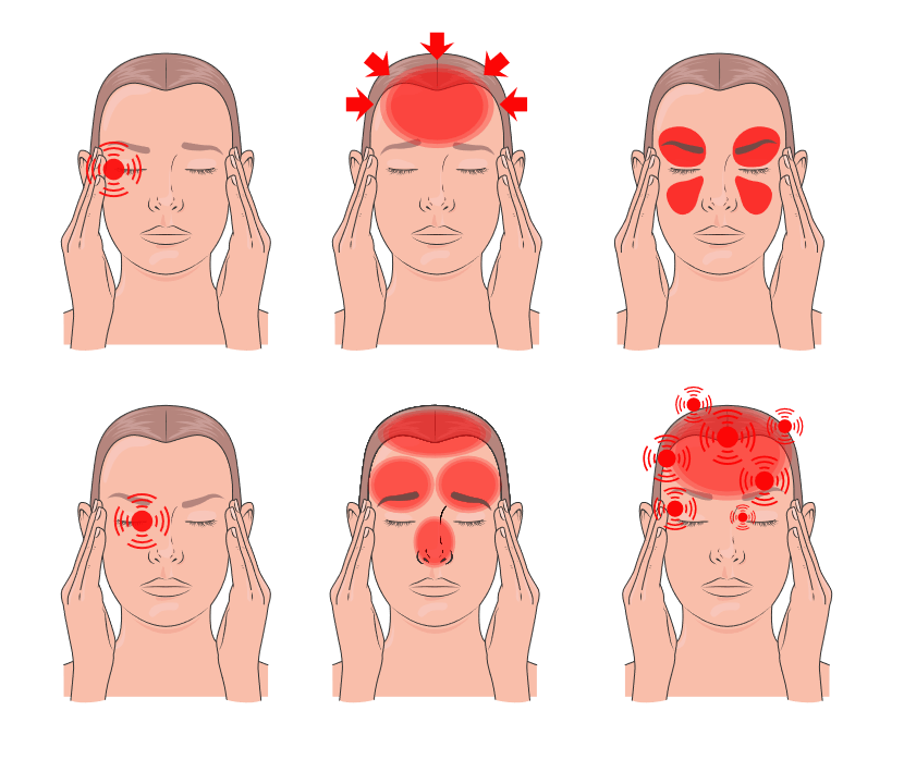 Anatomy illustration of Migraine