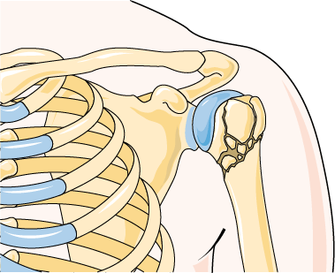 Anatomy illustration of Shoulder Pain