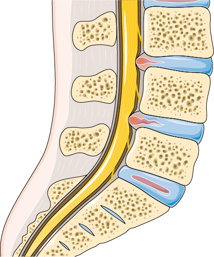 Anatomy illustration of Slipped Disc