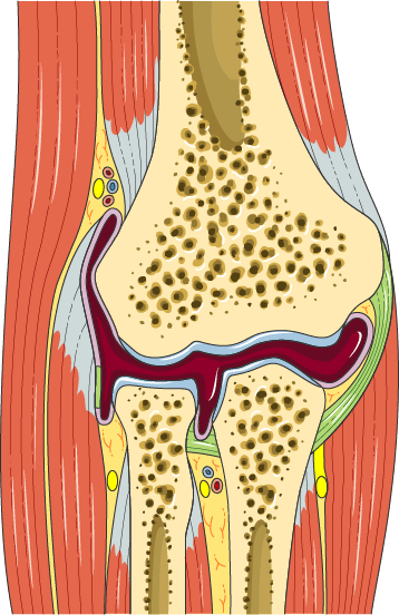 Anatomy illustration of Tennis Elbow