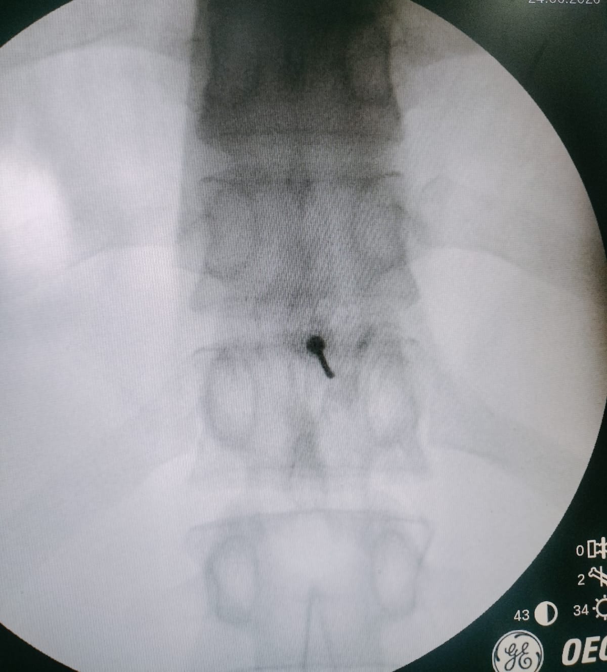Steroid Injections at GABA Pain Center